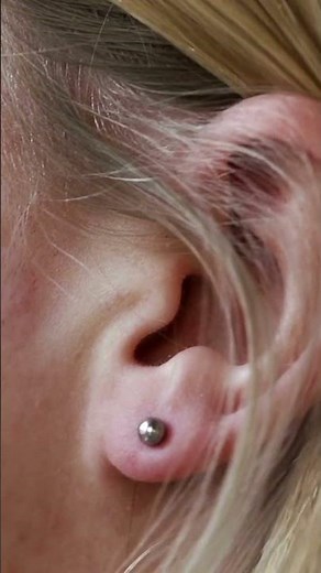 Acouphènes : Tapoter derrière l’oreille pour soulager