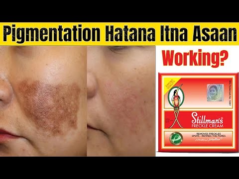 Freckles & Pigmentation Gone? Stillman’s Freckle Cream Full Review + Side Effects