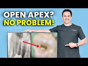 Apexification Made Easy | Step-by-Step Clinical Technique