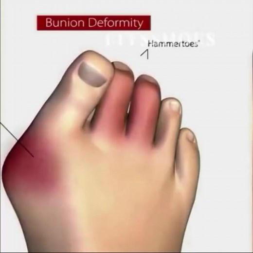 SKECHERS™ Women's Orthopedic Mesh Shoes – Now Available! Struggling with bunions, hammer toe, or poor posture? These shoes are made for you! ✅ Soft sole for all-day comfort ✅ Designed to relieve foot pain and pressure points ✅ Helps align posture and support natural movement ✅ Breathable mesh Anti-slip Anti-bacterial lining ✨ Pain-free walking starts here – stylish, supportive, and safe. 🛒 Grab your pair today 👉 | QT Fashion