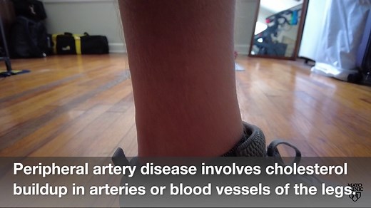 Mayo Clinic Minute: How is peripheral artery disease diagnosed? Dr. Amy Pollak, a Mayo Clinic cardiologist, explains how physicians identify peripheral artery disease and why an early diagnosis can reduce the risk of amputation, heart attack and stroke. https://mayocl.in/3KCkj2z | Mayo Clinic