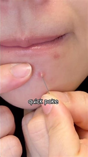 A huge pimple showed up #Fixcica #acnecare #pimple #aftercare #skintok