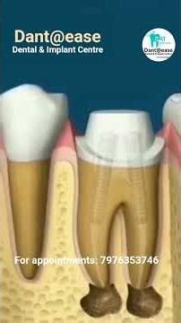 #teethdecay #dentist #wisdomtoothextraction #teethwhiteningprocedure #doctor