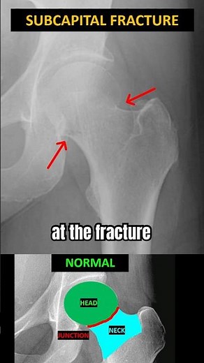 The Hip Fracture You Can’t Miss ⚠️