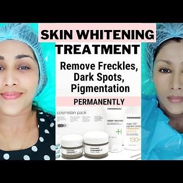 My Cosmelan 2 Experience for Skin Whitening Remove Melasma Colasma ✨ Cosmelan Peel Before and after