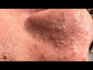 The Blackhead Video Everyone Is Watching