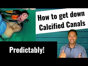 Root Canal with Calcified Canals and S Curve (Wave One Gold) • Video • MEDtube.net