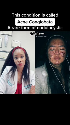 Understanding Cystic Acne Treatment: A Dermatologist's Guide