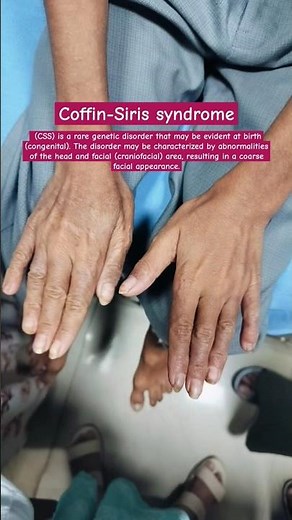 Coffin-Siris syndrome #peadiatric #genetics #cases #disease #congenital #study #medical #shorts #css