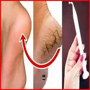 The final solution to get rid of the cracks of the feet with one candle in one day. Heal Your Cracked Heels Overnight, The Final Solution To get Rid Of Cracks On Feet. Remove Cracked Heels and Get Beautiful Feet - Magical Cracked Heels Home Remedy. | ELEGANT BEAUTY
