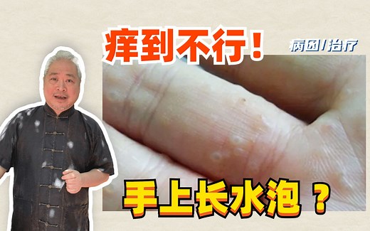 【皮肤科教授】小苏手上的小水泡到底是什么？怎么办？