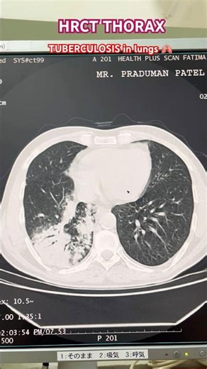 #shorts #short #shortsviral #explore ct scan of thorax #anatomy