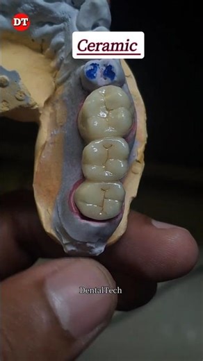 Posterior Ceramic bridge|| dental technician video| laboratory| ceramic video| dental lab| anatomy