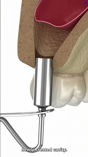 Direct Sinus Lift Surgery.