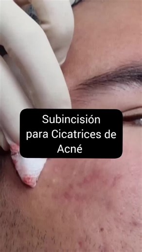 La Subincisión es un procedimiento médico dermatólogico indicado en cicatrices hundidas. A través de una aguja se rompe el tejido mal cicatrizado y se aplica un Bioestimulador para formar colágeno y elastina .#secuelasdeacne #dermatología