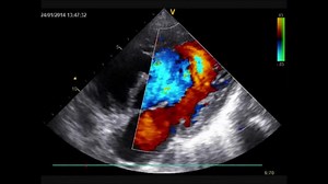 File:Percutaneous-closure-of-large-VSD-using-a-home-made-fenestrated-atrial-septal-occluder-in-18-year-1471-2261-14-74-S1.ogv - Wikimedia Commons