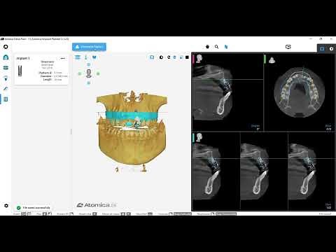 Atomica Implant Planner and Guide Design - AI Digital Dentistry Solutions