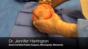 En Bloc breast implant removal, part 2 of 4