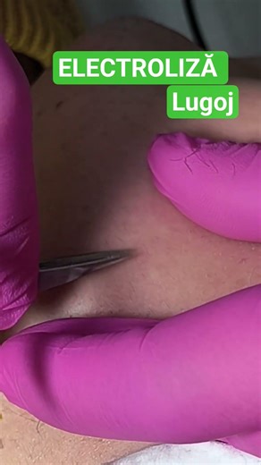 Electroliza este procedura prin care intervenim direct la nivelul foliculului pilos