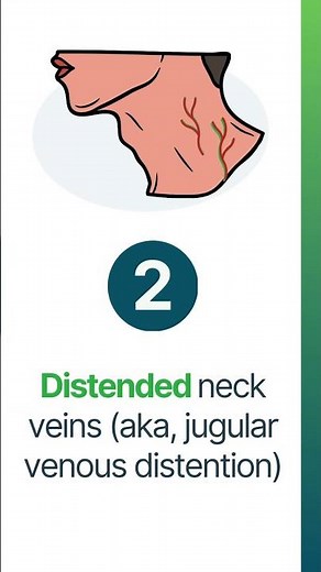 The 3 D’s of Cardiac Tamponade