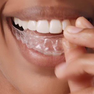 337 reactions · 46 shares | Teeth straightening that costs up to 60% less than braces. See if you're a candidate. | Smile Direct Club | Facebook