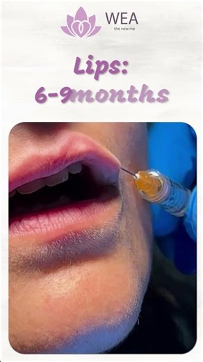 How Long Do Fillers Last? | Lips, Jawline & Cheeks