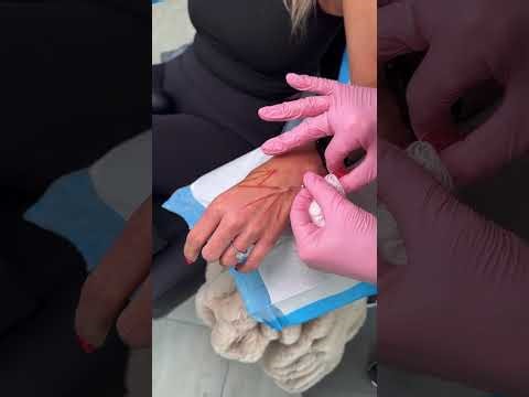 Hand Filler vs PRF: What Really Works for Aging Hands?