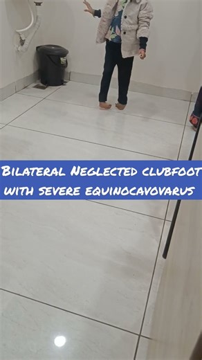 bilateral congenital talipes equinocavovarus foot or clubfoot or CTEV Walking on dorsolateral border