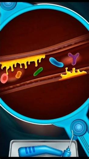 open heart valve surgery