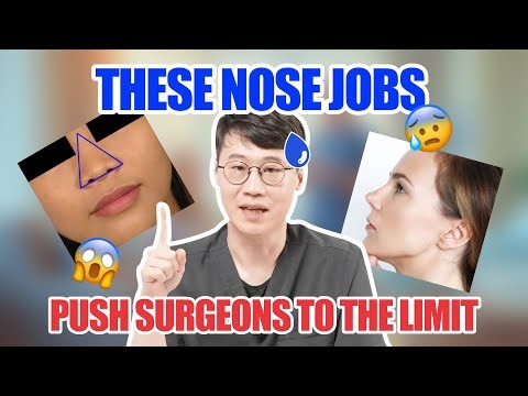 The nose jobs that push plastic surgeons to the edge