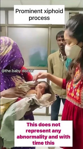 Prominent xiphoid process in newborn |the baby doctor #newborn #babyvideos #ytshorts #viralvideo