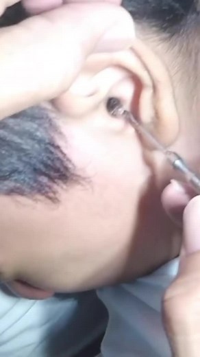 Just so easy ! #earwax #earwaxremoval #earcleaning #fyp #earwaxspecialist
