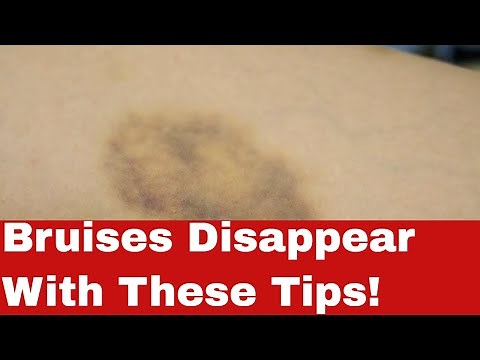 How to Get Rid of Bruises Fast -- Astonishingly Easy Steps!