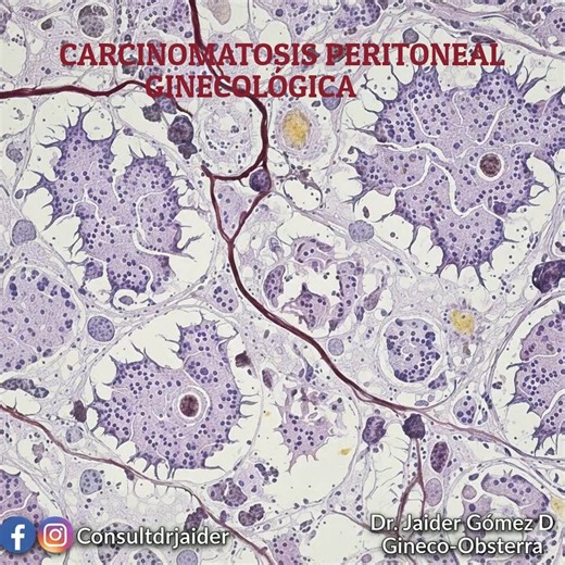 ✍🏻La Carcinomatosis Peritoneal Ginecológica, se refiere a la propagación de células tumorales al peritoneo pélvico-abdominal con o sin afectación ganglionar. ✍🏻El tumor epitelial ovárico, de trompas y uterino, se extiende localmente por continuidad o bien por extensión ganglionar. ✍🏻Tiene valor pronóstico al momento de aplicar quimioterapia y sus síntomas dependen de su extensión y afectación de estructuras cercanas por efecto de masa carcinomatosa inflamatoria y adherencial. ✍🏻Los síntomas 