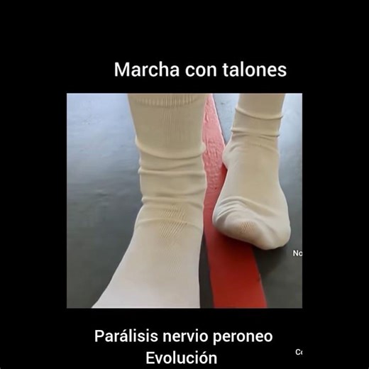 Parálisis nervio peroneo: evolucion