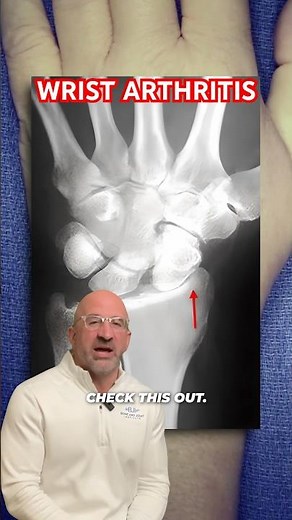 Wrist Arthritis Pain Fusion Relief #shorts