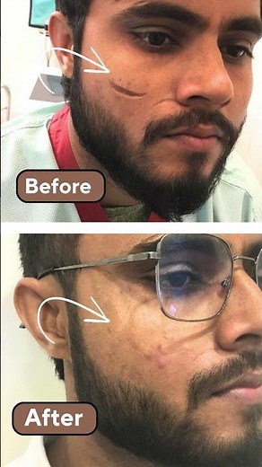 Scar Revision Treatment | Scar Revision Treatment After 9 Months | Invisible Scar #scarreduction