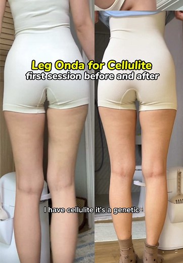 Understanding Cellulite and Circulation Issues