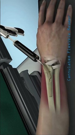Bone Fracture Repair #BoneFracture #FractureRepair #HealingBones #OrthopedicSurgery #BoneHealth