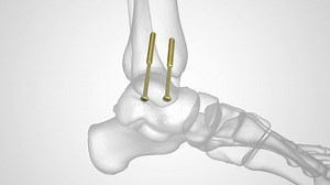 4.0 mm Cannulated Screw System Surgical Technique Overview Animation