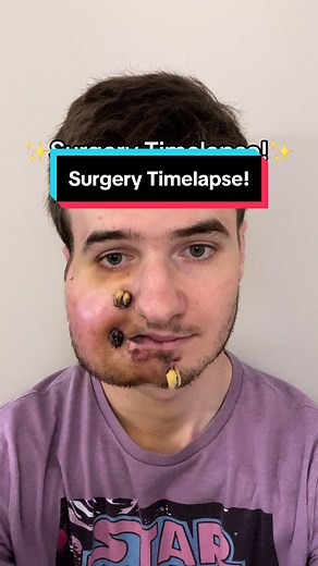 Timelapse of My Free Flap Surgery Recovery | Surgery Timelapse