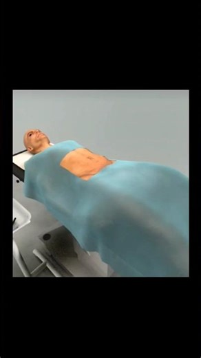 Open Appendectomy Surgery |Live Operative Steps #Surgery #MedicalEducation #OpenAppendectomy #shorts