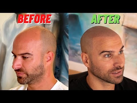SUPER NATURAL Scalp Micropigmentation Before and After w/ Matt Iulo