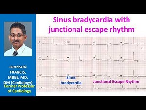 Sinus bradycardia with junctional escape rhythm