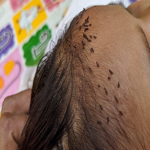 Remove all lice from black hair - Taking out all hundred lice from long hair | Jeramiah Mckenzie