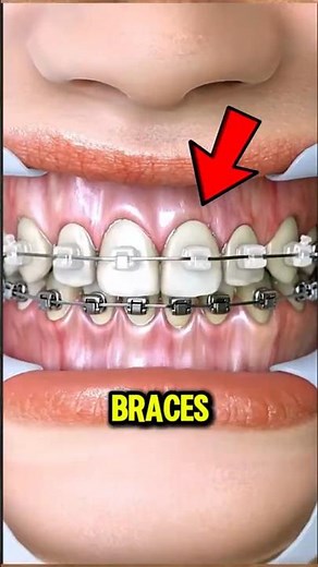 Braces Don’t Just Move Teeth… Here’s What Really Happens 😳