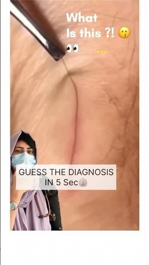 What is a Hair Splinter? Causes & Symptoms explained. | Dr. Alwi Zaman