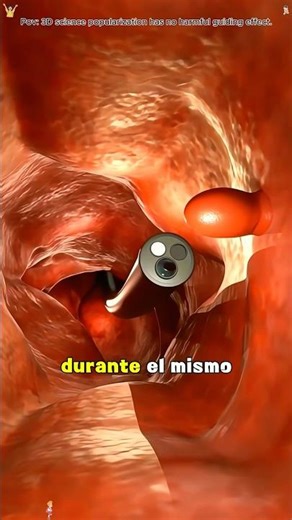 No Surgery Needed — Colon Polypectomy Explained! Medical animation #colonpolypectomy #colonoscopy