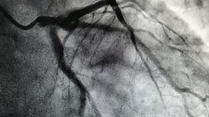 Coronary Artery Angiogram Left Coronary Artery Stock Footage Video (100% Royalty-free) 1018995016 | Shutterstock