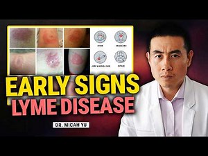 Early Warning Signs of Lyme Disease